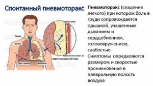 Боли после пневмоторакса