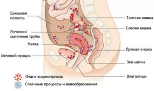 Боли в шейке матки и прямой кишке