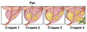 Карцинома 3в стадии или нет