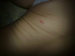 Красное пятнышко на спине у ребёнка