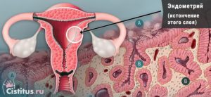 Планирование беременности и хр. Эндометрит+гипоплазия эндометрия