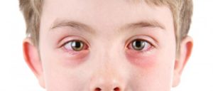 Красные глаза и температура