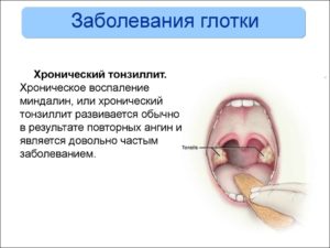 Как лечить Фарингоневроз