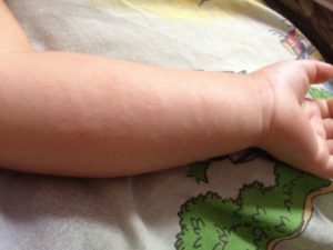 Крупная сыпь на руках и ногах у ребёнка с температурой