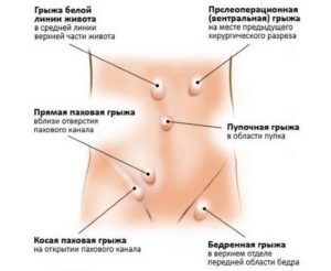 Колоноскопию при не впровляемой грыже белой линии живота