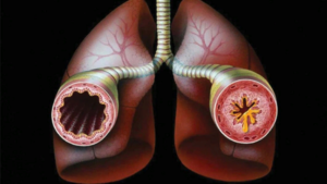 Бронхиальная астма и бронхит