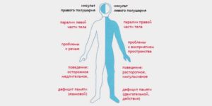 Ишемический инсульт, правосторонний гемипарез