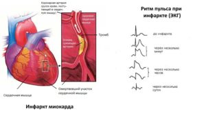 Инфаркт миокарда при нормальном давлении и пульсе