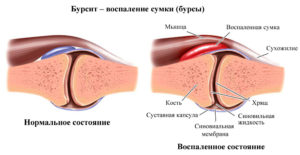 Лопнула суставная капсула