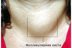 Кисты и аденома щитовидной железы