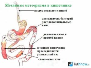 Боли при прохождении газов