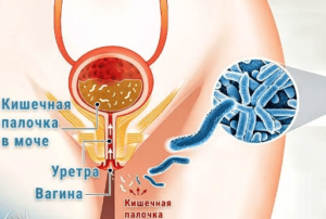 Кишечная палочка в уретре