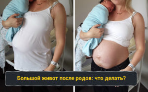 Большой живот после родов