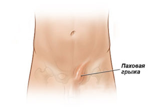 Была паховая грыжа и пропала