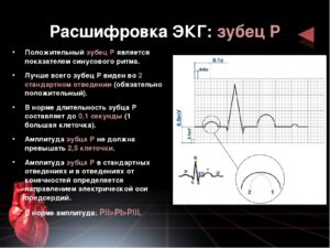 Как прочитать кардиограмму ЭКГ