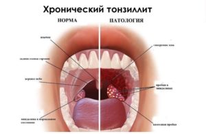 Кровит миндалина