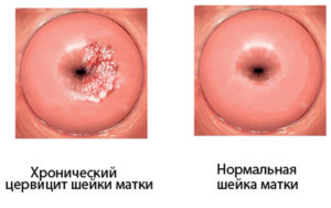 Хронический цервицит вместо дисплазии