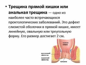 Лечение и диета при анальной трещине