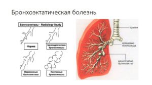 Бронхоэктатическая болезнь