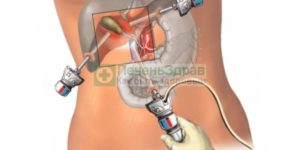 Лечение гастрита после удаления желчного пузыря