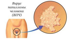 Планирование беременности. Кондиломы