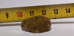 Камень в правой почке 4,5 мм