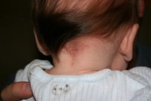 Красные пятна на лице и шеи у ребенка?