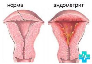 Коричневые выделения при эндометрите