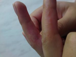 Красные пятна пальцах рук и между ними как лечить?
