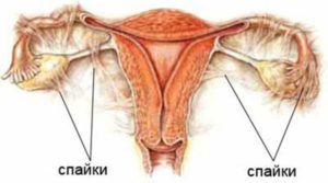 Боли слева спайки