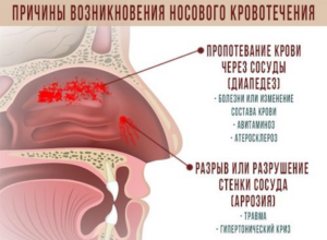 Кровотечение из носа и головокружение