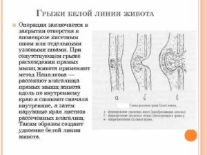 Колоноскопию при не впровляемой грыже белой линии живота