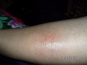 Красные пятна на голени ног, что это и как лечить?