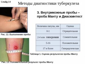 Кальцинаты при положительном диаскин тесте