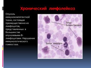 Боюсь лейкоза, лимфомы-анализ