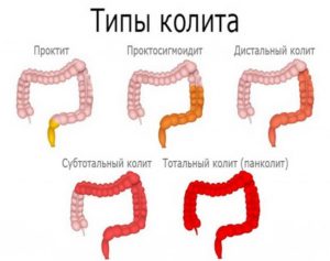 Как лечить катаральный колит, от него ли ли субфебрилитеет