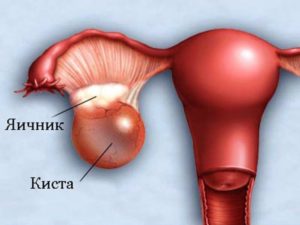 Киста яичника иногда боли в этом месте