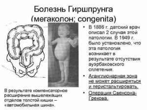 Мегадолихоколон субкомпенсированная форма