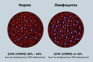 Лимфоцитоз или норма