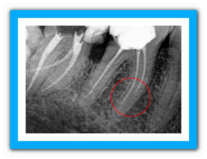 Болит запломбированный зуб без нерва