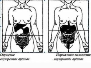 Какие исследования нужны при подозрении на опущение внутренних органов