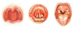 Хронический тонзиллит, фарингит