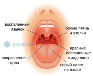 Бугорки на гланде