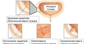 Кантарис С6 хронический цистит