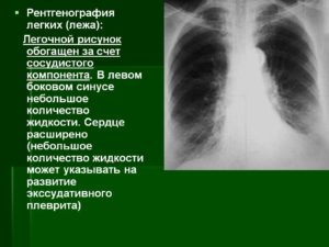 Легочный рисунок неравномерно обогащен