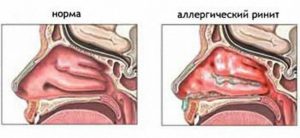 Периодическая слизь в горле, вазомоторный ринит