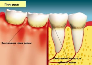 Болит десна возле зуба