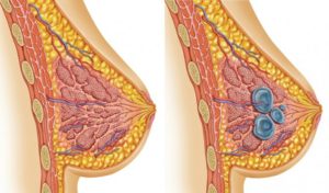 Мастопатия молочных желез 2-ой степени