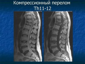 Компрессионный перелом 11 и 12 позвонков