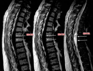 Ликворная многокамерная киста мягких тканей спины